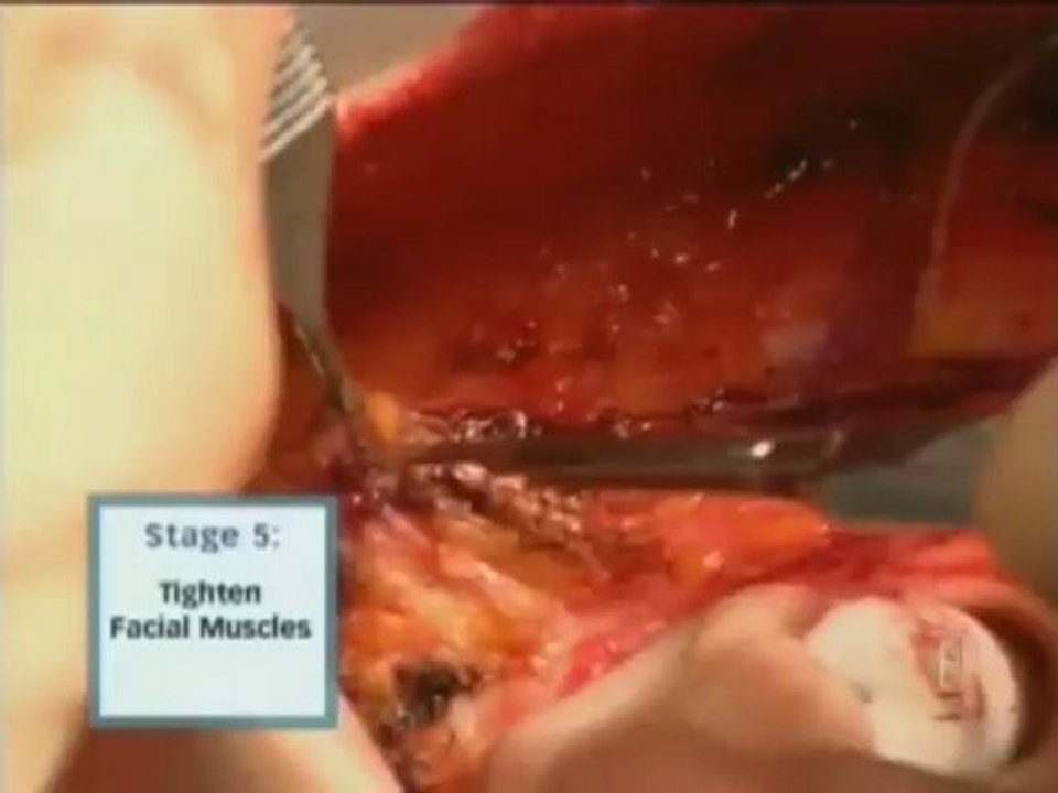 Dr Jason Diamond Reviews Mini Facelift Miracles on Dr 90210