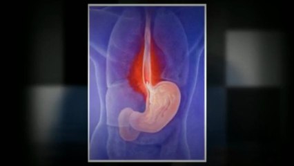 acid reflux foods to avoid