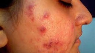 acne and pregnancy|acne and dairy|acne and birth control