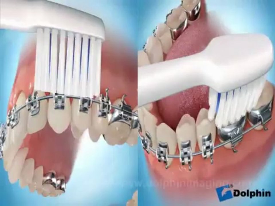 Brossage des dents avec un appareil dentaire