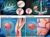 Olive oil helps prevent embolic strokes - Shimon Haber