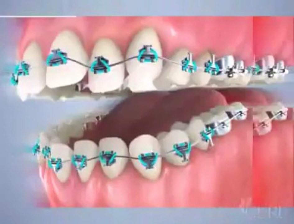 Traitement multi-attaches