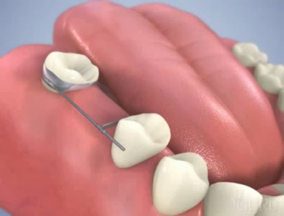 orthodent Orthodontie pré-prothétique