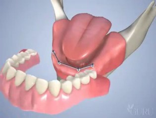 dentiste chirurgien Pose de 4 implants avec une barre d'attachement