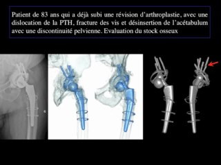 Prothèse totale de hanche - Impact du MAR