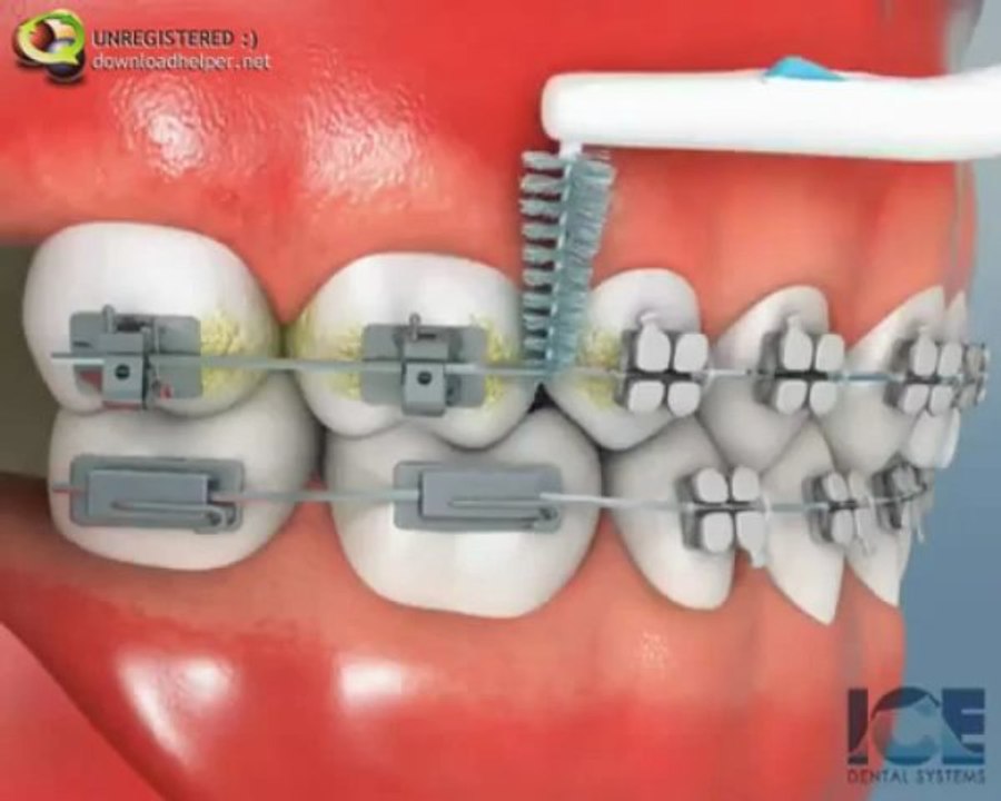 Brossettes interdentaires avec brackets orthodontiques