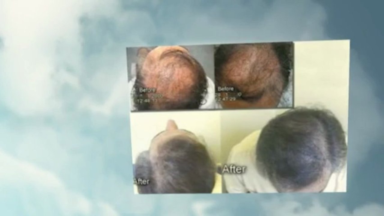 Hair Transplant