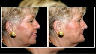 Chicago Implant Dentist Presents Premature Aging Caused By Bone Loss