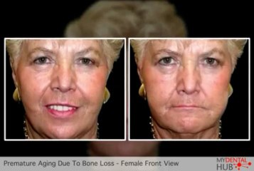 Implant Dentist In Chicago Explains How Bone Loss Causes Premature Aging