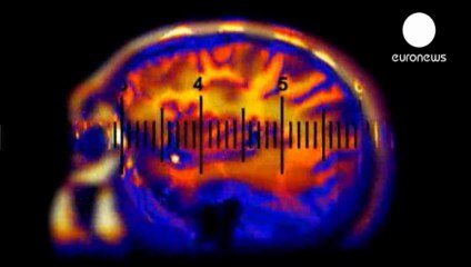 Investigacion genetica y el escáner en 3D: Autismo