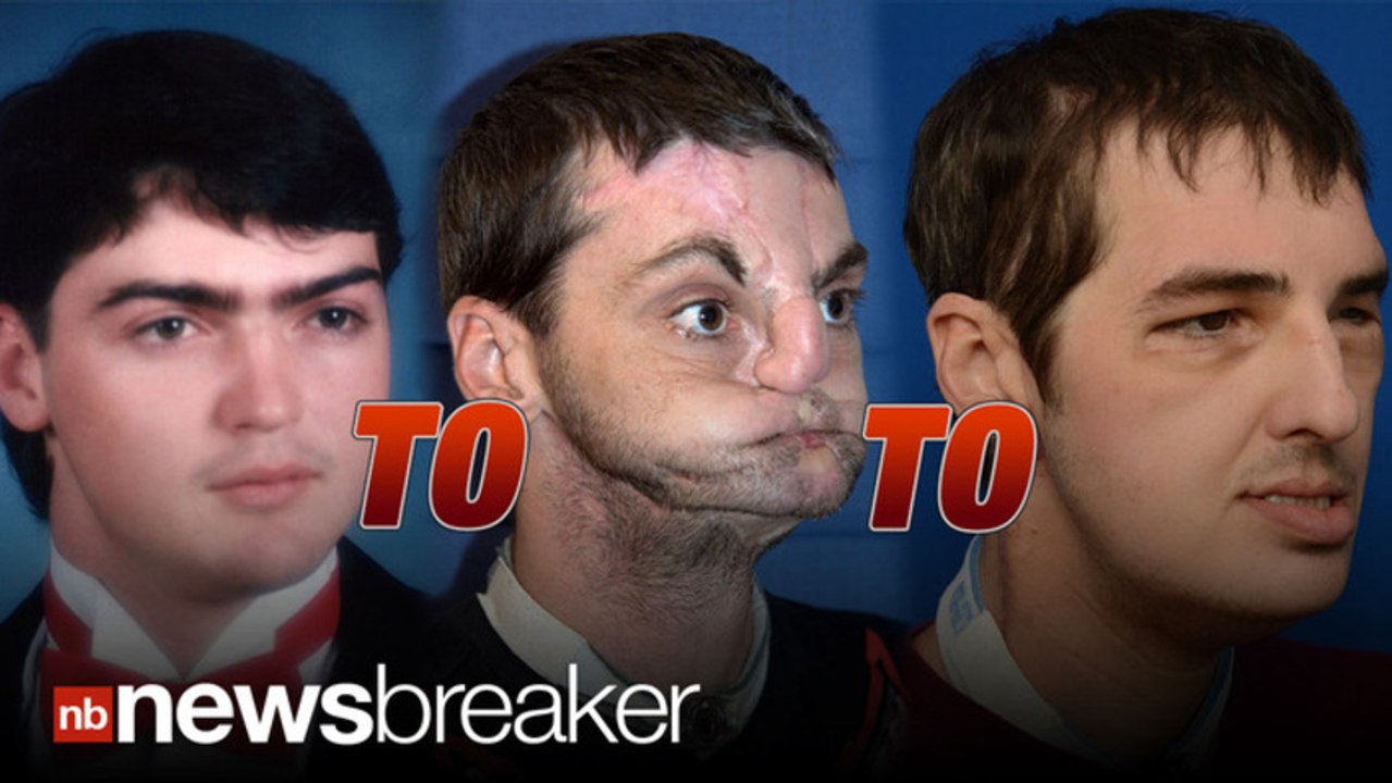 SAVING FACE: Historic Face Transplant Allows Disfigured Gunshot Victim New Life