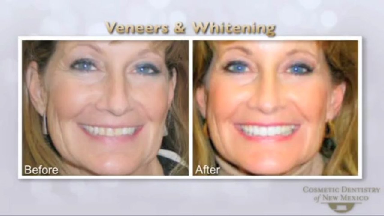Vicki Discusses Her Smile Makeover