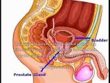 Enlarged Prostate Rectal Discomfort - What Is The Link Between Enlarged Prostate And Rectal Discomfort