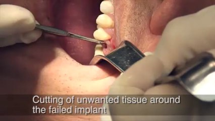 Dental Implant Complication Dentist Dr. Yamada