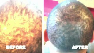 Hair Tattoo Tutorial: Cure Baldness and Stop Hair Loss