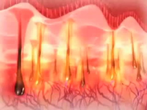 Laser Hair Removal at Oliva Skin Clinic,Hyderabad.m4v