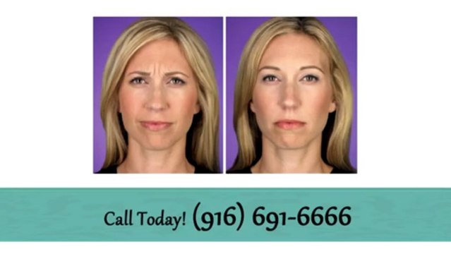 Botox Elk grove CA - Dr. Mahmoud Khattab, M.D.