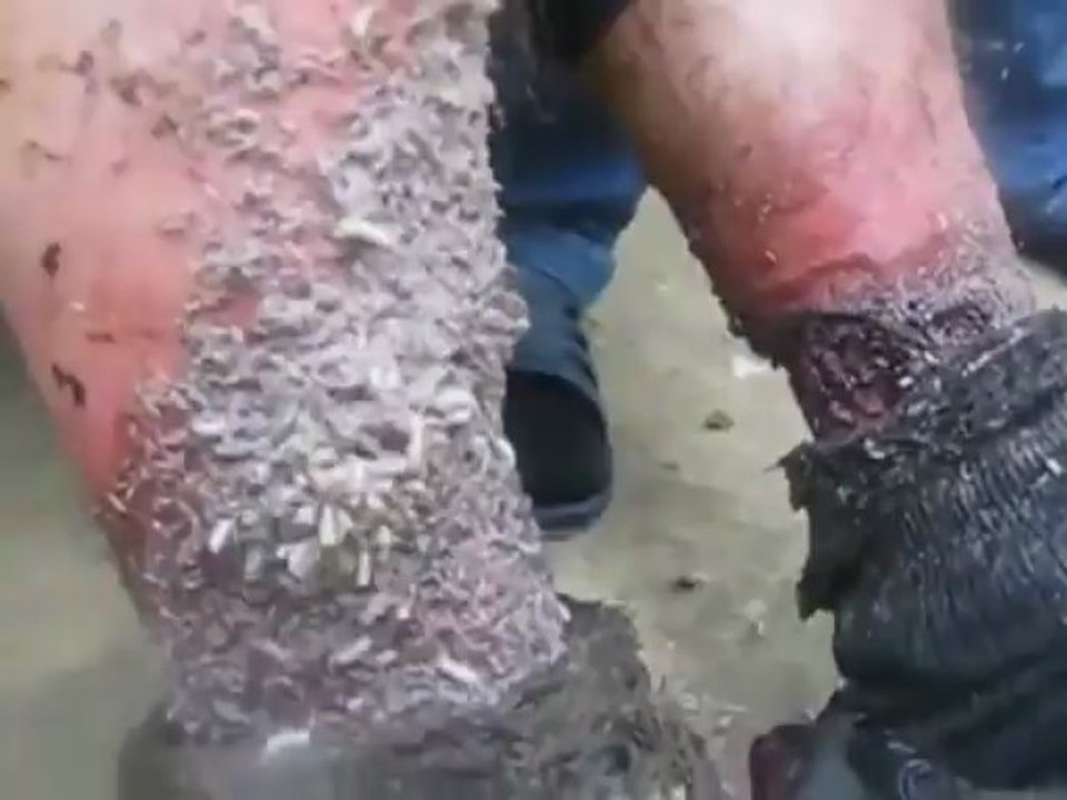 Man with Nasty Foot Infection needs to Change his Socks