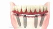 New Jersey Dental Implants Done The 