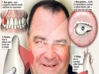 WTF- Tooth Implanted In Eye To Regain Blindness