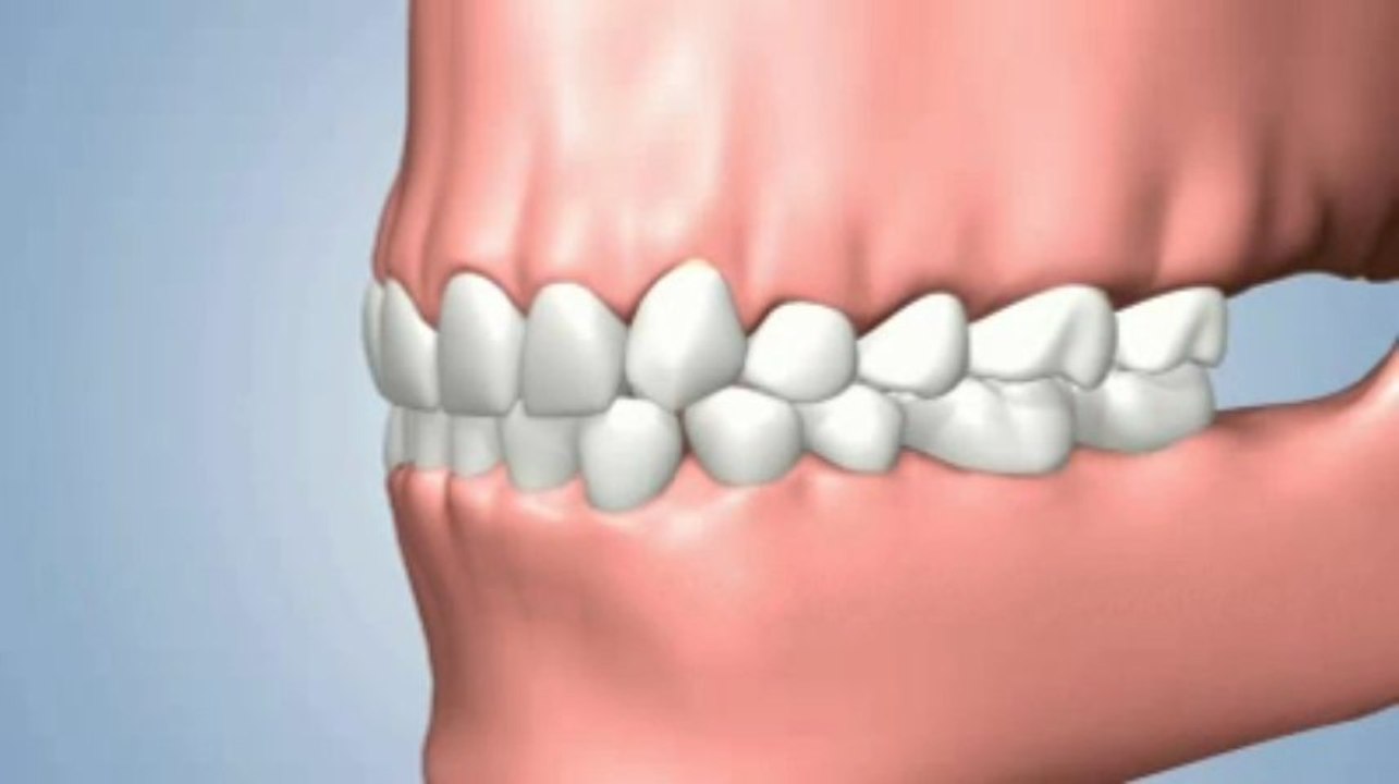 Several-Teeth-Missing-Consequenses-of-Non-Treatment