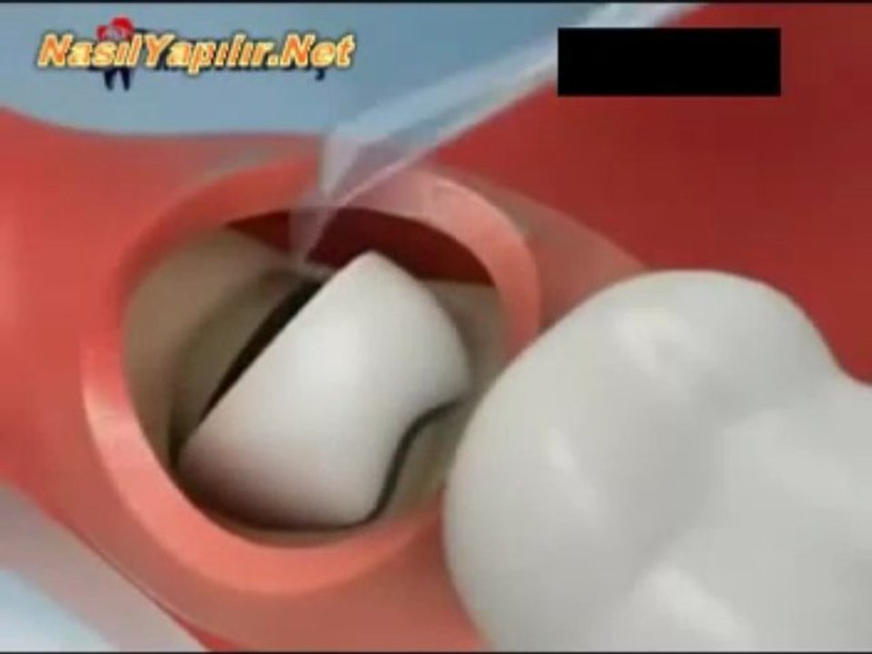 20'lik Diş Çekimi Nasıl Yapılır