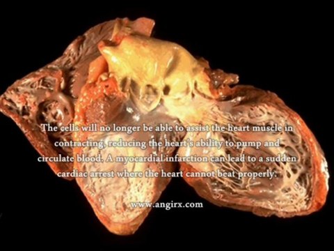 Coronary Artery Disease vs Myocardial Infarction - What Is The Best Treatment For Coronary Artery Disease And Myocardial Infarction?