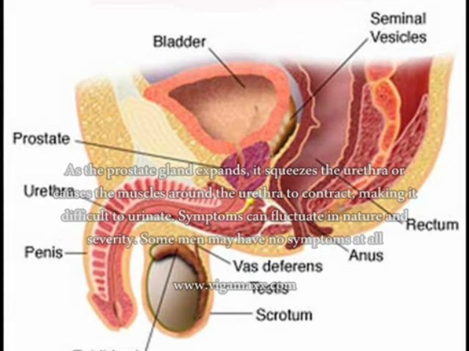 BPH Symptoms Bleeding, What Is The Best Treatment For BPH Symptoms With Bleeding?