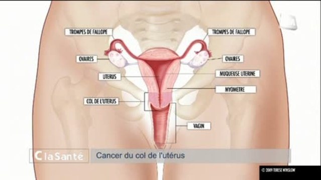 C La Santé : Papillomavirus, le Cancer du Col de l'Utérus