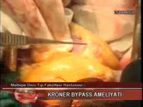 Çalışan Kalpte Bypass - Çay Tv - Op. Dr. Mahmut Akyıldız