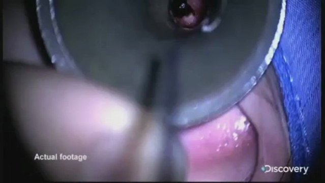 British Woman finds FLESH-EATING MAGGOTS in her Ear Canal