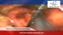 Key Hole Heart Surgery in India | Minimally Invasive cardiac Surgery