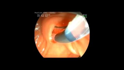 Kayıhan Günay  ERCP