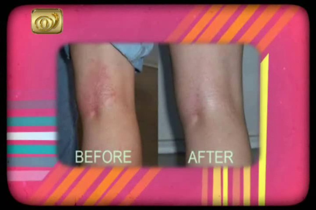 Natural healing home remedies for eczema, Eczema Free Forever