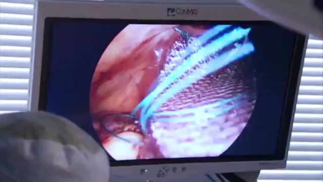 Hernia repair in Beverly Hills