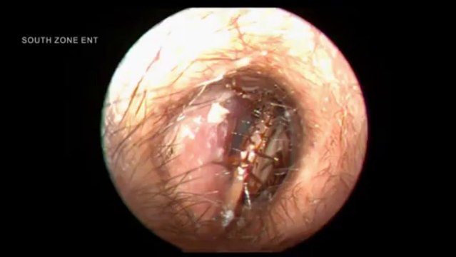 Cafard vivant dans l'oreille