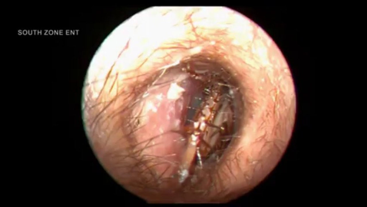 Cafard vivant dans l'oreille