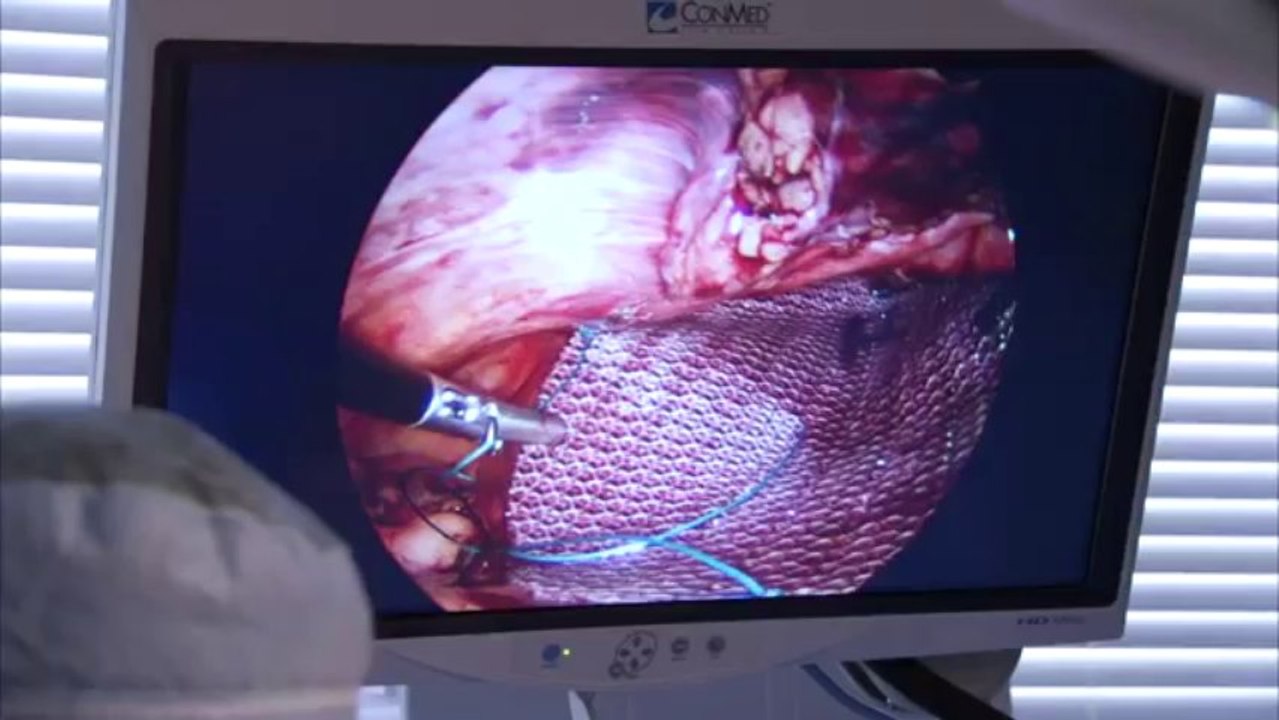 Hernia repair in Los Angeles