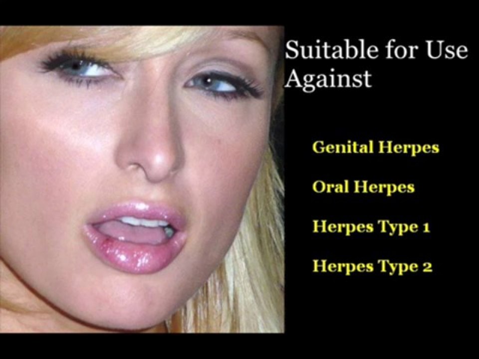 Herpes Simplex 2 - How to Get rid of Herpes Simplex 2 Virus forever!