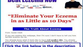 Best Treatment For Eczema + Beat Eczema Review