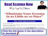 Beat Eczema Now   Beat Eczema Susan Clark