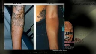 Get Rid Tattoo | How To Get Rid Of A Tattoo Naturally