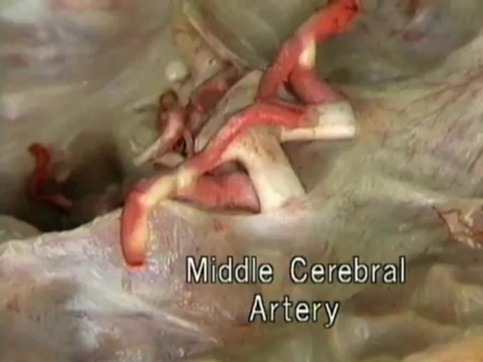 Acland's Video Atlas of Human Anatomy: Anterior Cerebral Artery