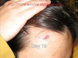 Mole,Wart and Skin Tags Removal without surgery