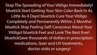 Natural Vitiligo Treatment System +DISCOUNT+