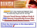 Banish Tonsil Stones Guide   Banish Tonsil Stones