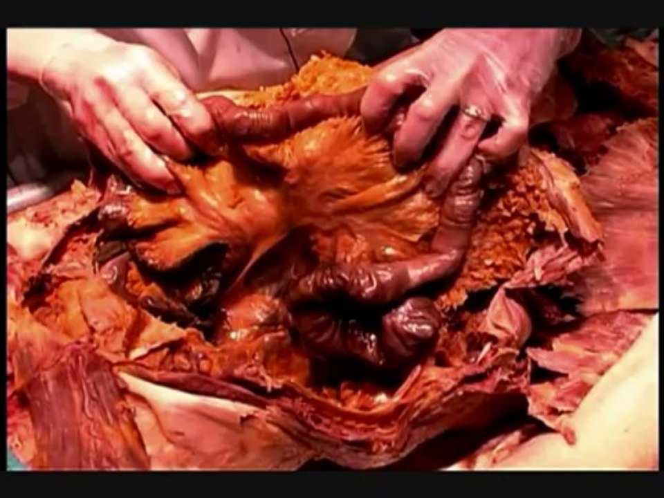 Human Anatomy Dissection 06 (part 1 of 2) Peritoneal Cavity