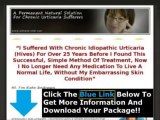 Urticaria Relief Itching   Natural Urticaria Relief Download