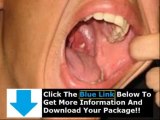 Banish Tonsil Stones Pdf   Diane Puttman Banish Tonsil Stones Pdf