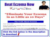 Beat Eczema By Susan Clark   Beat Eczema Cream
